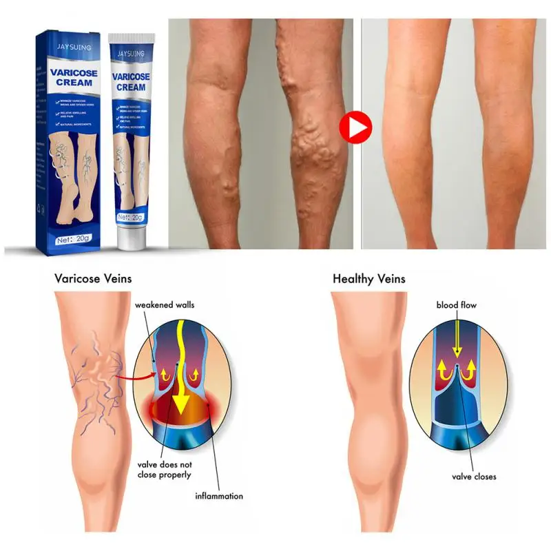 

Крем для восстановления варикозного расширения вен, 20 г, инструмент для ухода за кожей ног