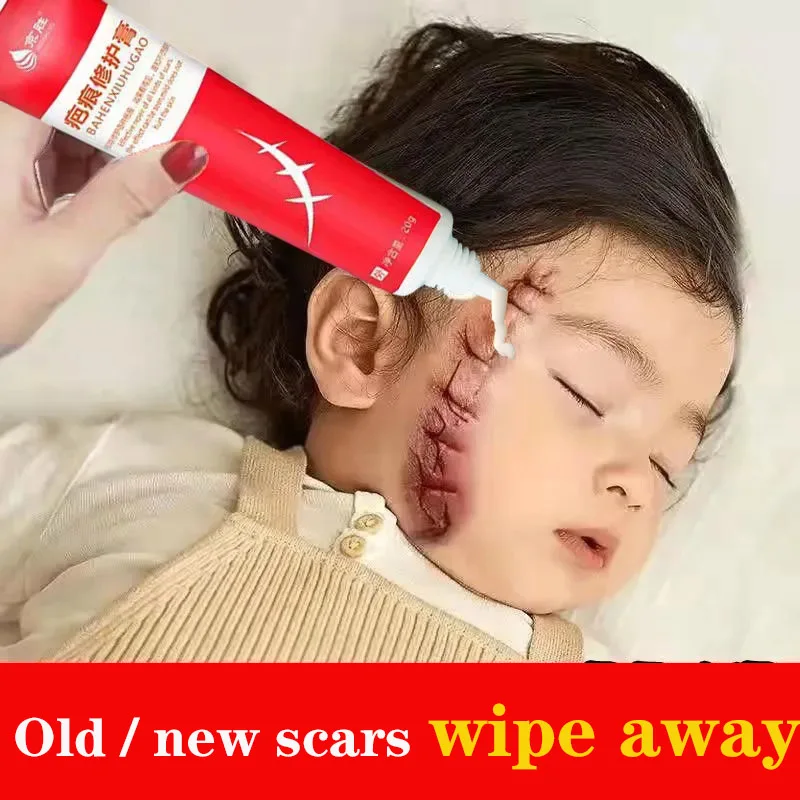 Acne Surgical Scar Removal Cream Pimples Stretch Marks Face Gel Remove Acne Smoothening Whitening Body Skin Care PigmentationS
Acne Surgical Scar Removal Cream Pimples Stretch Marks Face Gel Remove Acne Smoothening Whitening Body Skin Care PigmentationS