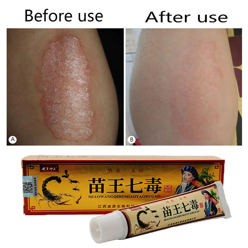 Psoriasis Dermatitis Eczematoid Eczema Ointment Cream Adults And Children ( With Retail Box)
Psoriasis Dermatitis Eczematoid Eczema Ointment Cream Adults And Children ( With Retail Box)