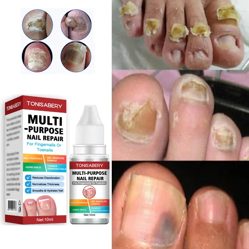 Быстрое лечение ногтей от грибка эссенция против инфекций средство для ухода за ногами Paronychia Onychomycosis ногтей грибок ремонт 
Быстрое лечение ногтей от грибка эссенция против инфекций средство для ухода за ногами Paronychia Onychomycosis ногтей грибок ремонт