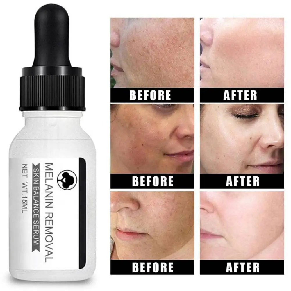 15ml Whitening Remove Freckle Face Serum Fade Dark Spots Melasma Melanin Brightening Moisturizing Facial Essence Acne Treatment
15ml Whitening Remove Freckle Face Serum Fade Dark Spots Melasma Melanin Brightening Moisturizing Facial Essence Acne Treatment