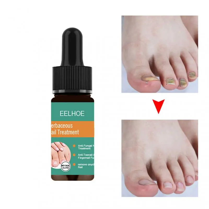 EELHOE 30ml Fungal Onychomycosis Liquid Hand And Foot Onychomycosis Care And Repair Antibacterial Thickening Nail Treatments 
EELHOE 30ml Fungal Onychomycosis Liquid Hand And Foot Onychomycosis Care And Repair Antibacterial Thickening Nail Treatments