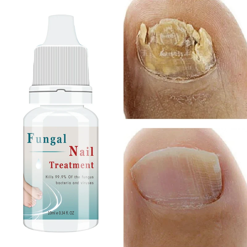

Сыворотка для лечения грибка ногтей, эссенция для восстановления ногтей на ногах, гель для удаления грибка на ногтях, антиинфекционный крем для паронихии и онихомикоза 10 мл