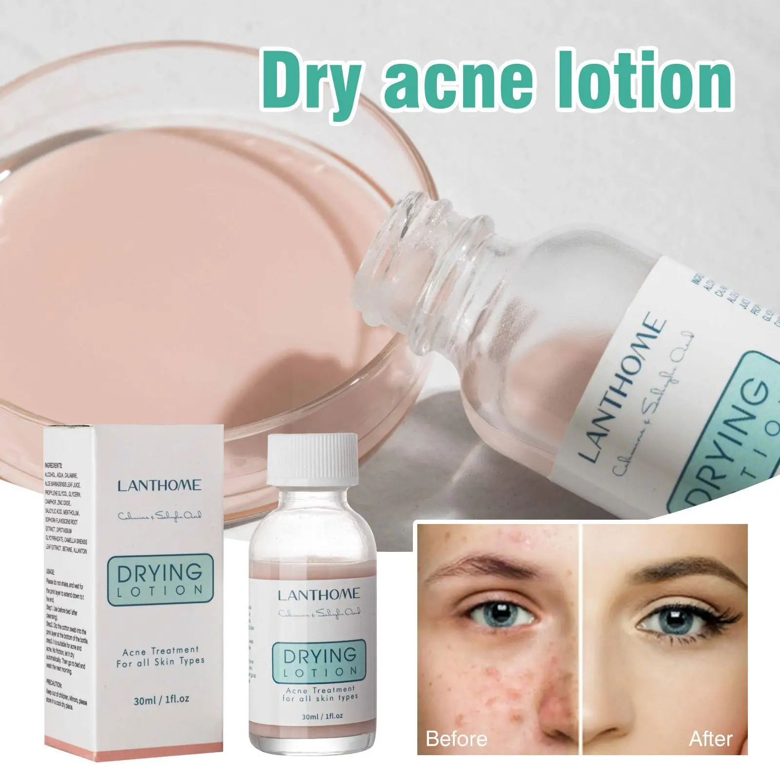 Effective Acne Removal Lotion Herbal Acne Spots Oil Acne Pores Gel Moisturizing Shrink Cream Control Ca Whitening Anti-acne F9c1
Effective Acne Removal Lotion Herbal Acne Spots Oil Acne Pores Gel Moisturizing Shrink Cream Control Ca Whitening Anti-acne F9c1