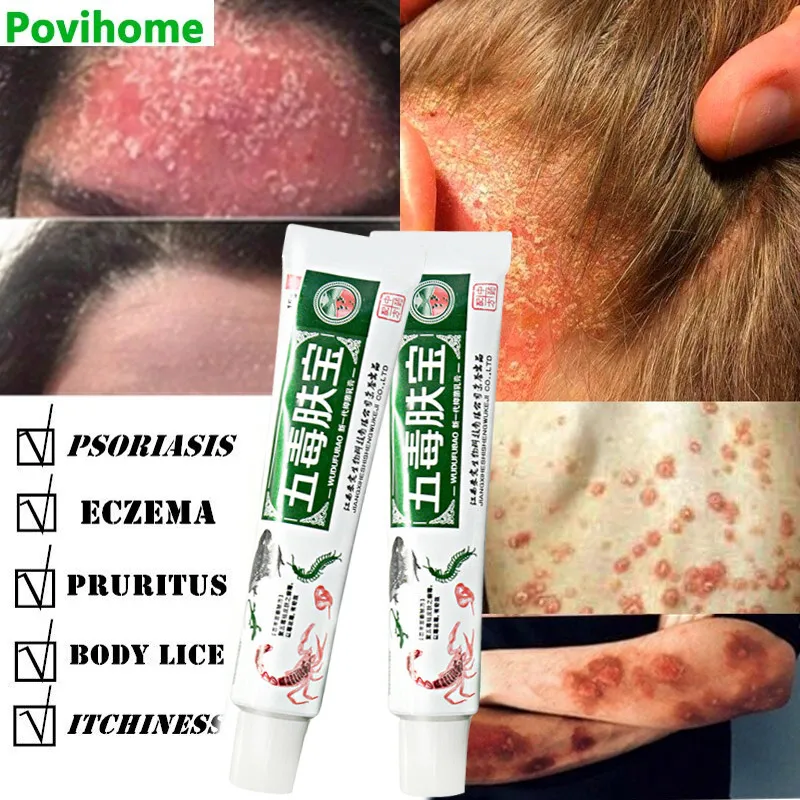 Antibacterial Psoriasis Cream Herbal Effective Anti-Itch Relief Dermatitis Eczema Treatment Urticaria Desquamation Skin Care
Antibacterial Psoriasis Cream Herbal Effective Anti-Itch Relief Dermatitis Eczema Treatment Urticaria Desquamation Skin Care