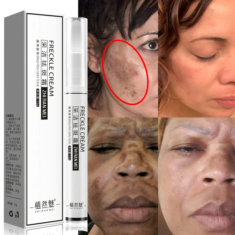 Whitening Freckles Cream Remove Melasma Dark Spot Lightening Melanin Removal Melasma Remover Moisturize Brighten Face Skin Care 
Whitening Freckles Cream Remove Melasma Dark Spot Lightening Melanin Removal Melasma Remover Moisturize Brighten Face Skin Care