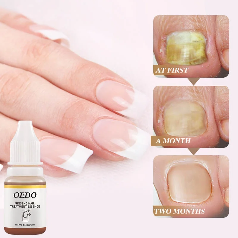 Healthy Hand Foot Nail Care Fungus Nail Repair Essential Oil Hand Foot Bright White Toe Nail Remove Fungus Infected 10ml
Healthy Hand Foot Nail Care Fungus Nail Repair Essential Oil Hand Foot Bright White Toe Nail Remove Fungus Infected 10ml