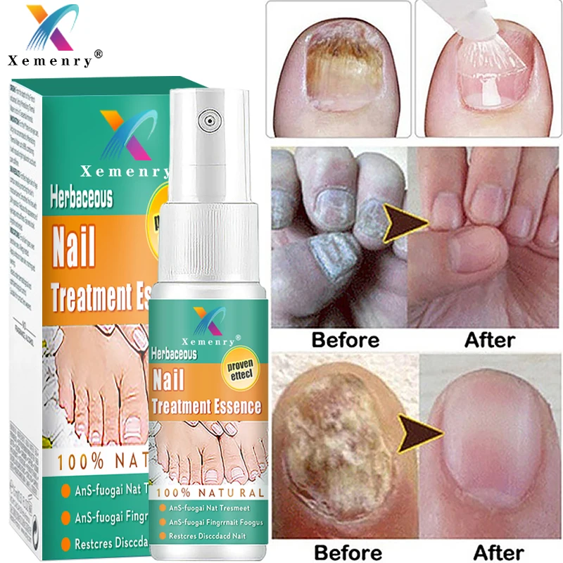 Nail Repair Spray Nail Fungus Treatment Serum Onychomycosis Paronychia Antifungal Nail Infections Toe Fungus Foot Restorative
Nail Repair Spray Nail Fungus Treatment Serum Onychomycosis Paronychia Antifungal Nail Infections Toe Fungus Foot Restorative