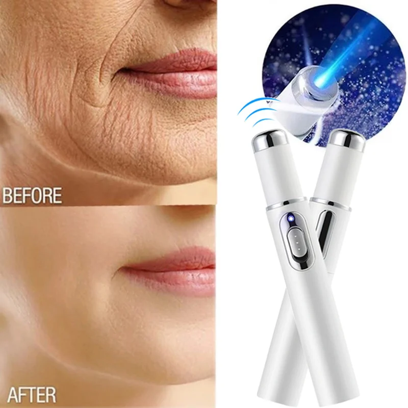 Лазерная ручка для удаления морщин, удаление пятен на коже, удаление варикозного расширения вен, ластик для лечения, портативный медицинский инструмент для лечения синим светом
Лазерная ручка для удаления морщин, удаление пятен на коже, удаление варикозного расширения вен, ластик для лечения, портативный медицинский инструмент для лечения синим светом