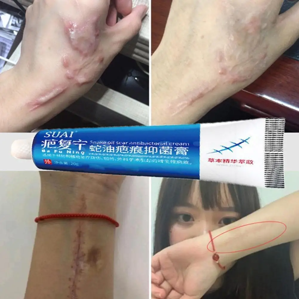 Acne Surgical Stretch Marks Removal Scar Cream Pimples Surgical Scar Cesarean Scar Stretch Marks Smooth Moisturizing Skin Care
Acne Surgical Stretch Marks Removal Scar Cream Pimples Surgical Scar Cesarean Scar Stretch Marks Smooth Moisturizing Skin Care
