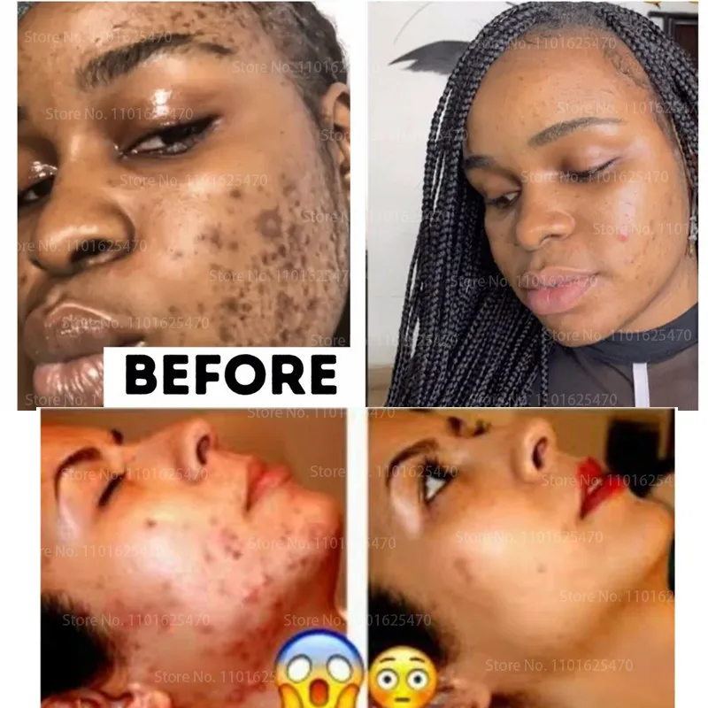 Authentic Intensive Whitening Serum Whitening Lotion Skincare for Dark Skin, Face, Knuckles, Elbows, Fingers and Inner Thighs
Authentic Intensive Whitening Serum Whitening Lotion Skincare for Dark Skin, Face, Knuckles, Elbows, Fingers and Inner Thighs