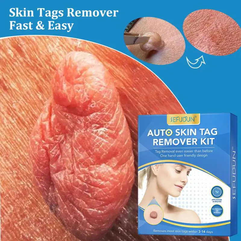1~5PCS Double Headed Wart Removing Pen Set Auto Skin Tag Remover Painless Set Wart Skin Tag Removal Kit Skin Care Beauty Health
1~5PCS Double Headed Wart Removing Pen Set Auto Skin Tag Remover Painless Set Wart Skin Tag Removal Kit Skin Care Beauty Health