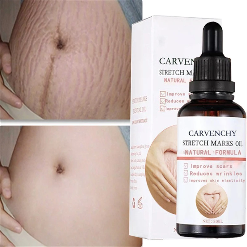 Stretch Marks Remover Essential Oil Pregnancy Maternity Body New Old Stretch Mark Removal Serum Increase Elasticity of Skin
Stretch Marks Remover Essential Oil Pregnancy Maternity Body New Old Stretch Mark Removal Serum Increase Elasticity of Skin