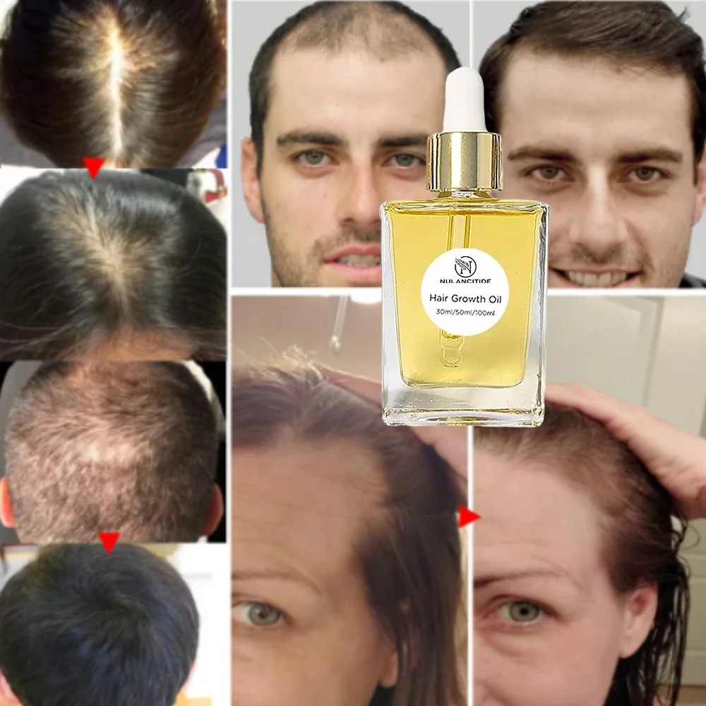 Hair growth essential oil natural anti-hair loss rapid growth to prevent hair loss hair treatment products for men and women
Hair growth essential oil natural anti-hair loss rapid growth to prevent hair loss hair treatment products for men and women