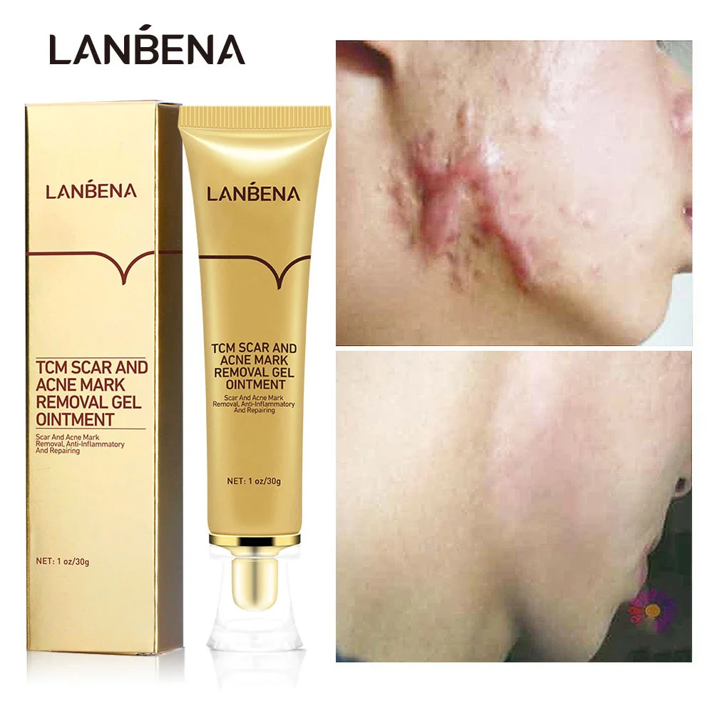 Acne Scar Removal Cream Stretch Marks Treatment Pimples Acne Spots Surgical Scars Repair Gel Whitening Smooth Skin Care Products
Acne Scar Removal Cream Stretch Marks Treatment Pimples Acne Spots Surgical Scars Repair Gel Whitening Smooth Skin Care Products