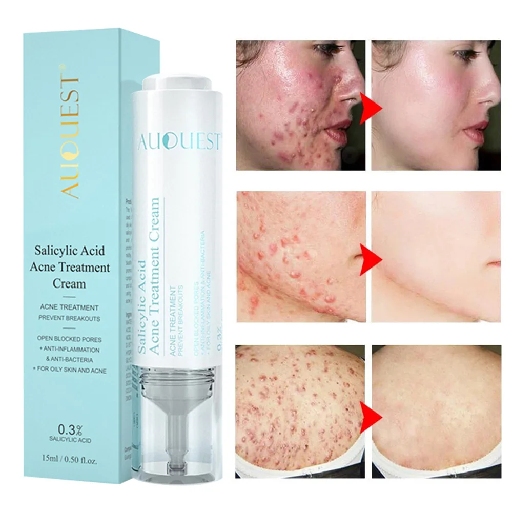 15ML Salicylic Acid Acne Treatment Cream Repair Acne Skin Oil Control Shrink Pores Skin Moisturizing Repairing Cream Skin Care
15ML Salicylic Acid Acne Treatment Cream Repair Acne Skin Oil Control Shrink Pores Skin Moisturizing Repairing Cream Skin Care