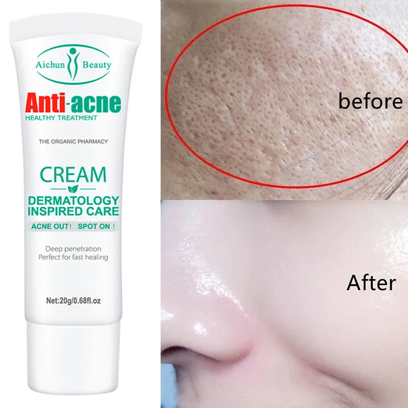 Salicylic Shrink Pores Cream Fast Repair Fade Acne Spots Exfoliating Moisturizing Nourishing Firming Skin Care Korean Cosmetics
Salicylic Shrink Pores Cream Fast Repair Fade Acne Spots Exfoliating Moisturizing Nourishing Firming Skin Care Korean Cosmetics