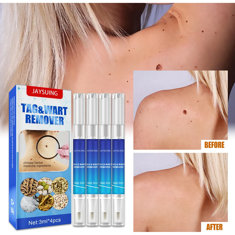 Removing Against Moles Liquid Pen Treatment Papillomas Removal Of Warts Liquid From Skin Tags Remover Anti Verruca Remedy 1/3pcs
Removing Against Moles Liquid Pen Treatment Papillomas Removal Of Warts Liquid From Skin Tags Remover Anti Verruca Remedy 1/3pcs