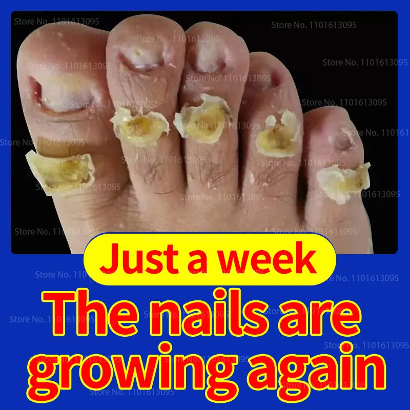 Nail Fungus Treatment Foot Care Essence Nail Foot Whitening Toenail Fungus Removal Gel Anti-Infective Paronychia Onychomycosis
Nail Fungus Treatment Foot Care Essence Nail Foot Whitening Toenail Fungus Removal Gel Anti-Infective Paronychia Onychomycosis