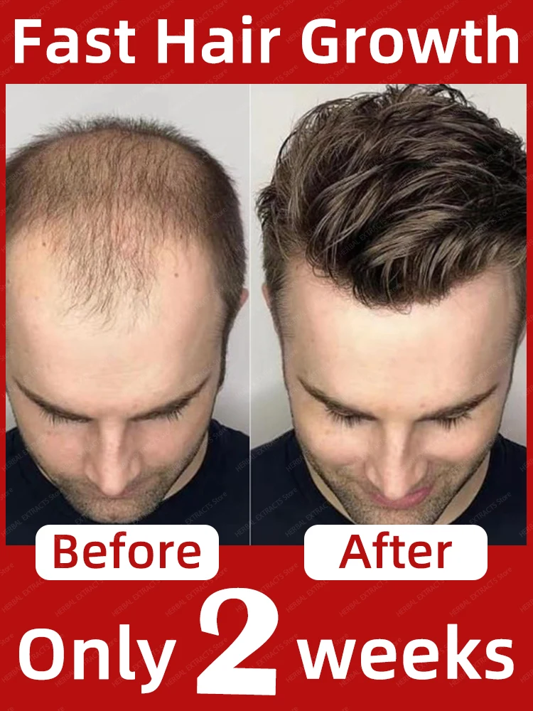Fast Hair Growth Hair Follicle Treatment Hair Growth Seborrheic Alopecia Hairline Upward Postpartum Hair Loss Baldness Hair Loss
Fast Hair Growth Hair Follicle Treatment Hair Growth Seborrheic Alopecia Hairline Upward Postpartum Hair Loss Baldness Hair Loss