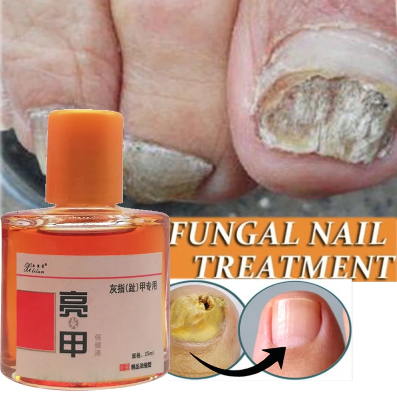 

Антибактериальный раствор для лечения грибка ногтей, Сыворотка от серых ногтей, жидкость против инфекции пальцев ног, противоинфекционные продукты, 25 мл