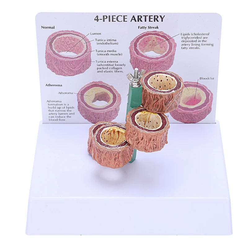 Atherosclerosis Thrombosis Model Vascular Disease Demonstration Heart Vascular Pathology Model
Atherosclerosis Thrombosis Model Vascular Disease Demonstration Heart Vascular Pathology Model