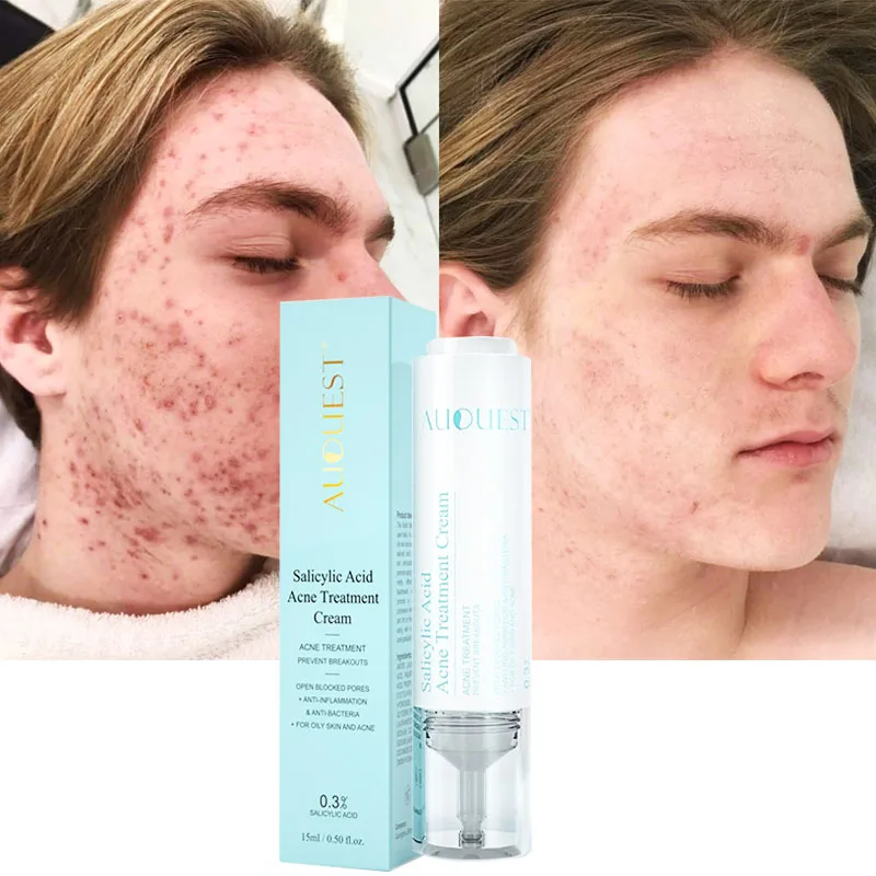 15ml Salicylic Acid Acne Treatment Face Cream Anti-acne Gel Fade Acne Scars Shrink Pores Remove Blackheads Skin Care Cosmetic
15ml Salicylic Acid Acne Treatment Face Cream Anti-acne Gel Fade Acne Scars Shrink Pores Remove Blackheads Skin Care Cosmetic