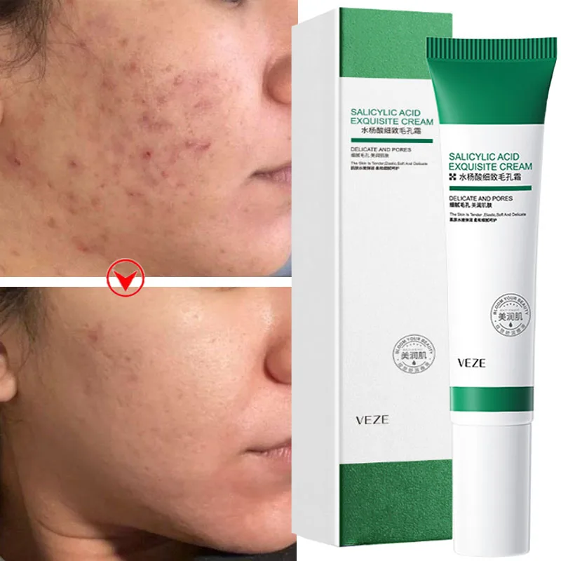 Salicylic Acid Pores Shrink Cream Moisturizing Repairing Remove Blackhead Acne Blemish Treatment Oil Control Face Skin Care 20ML
Salicylic Acid Pores Shrink Cream Moisturizing Repairing Remove Blackhead Acne Blemish Treatment Oil Control Face Skin Care 20ML