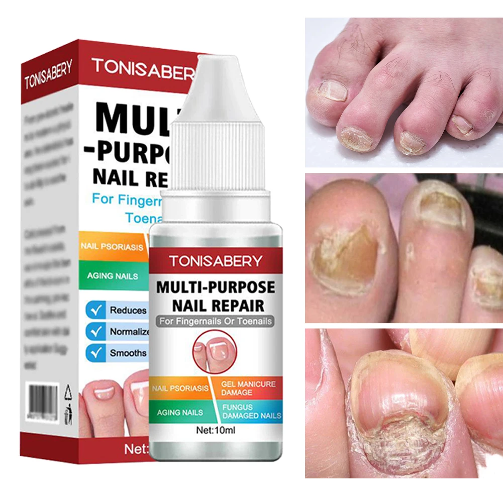 10ml Feet Care Nail Fungal Treatment Serum Anti Infection Nail Repair Essence Onychomycosis Paronychia Nail Fungal Removal Gel
10ml Feet Care Nail Fungal Treatment Serum Anti Infection Nail Repair Essence Onychomycosis Paronychia Nail Fungal Removal Gel