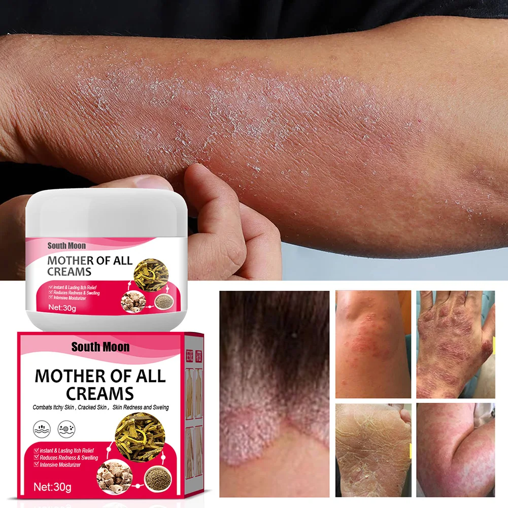 

30g Skin Psoriasis Cream Natural Herbal Ointment Relieve Itching Swelling Anti-Itch For Dermatitis Eczematoid Eczema Skin Care