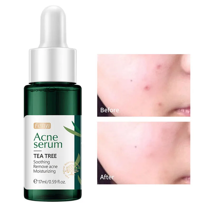 Organic Tea Tree Oil Serum Melasma Dark Spot Remover For Face Clareador De Pele Emulsionen Glutathion Skin Whitening Toner Cream
Organic Tea Tree Oil Serum Melasma Dark Spot Remover For Face Clareador De Pele Emulsionen Glutathion Skin Whitening Toner Cream