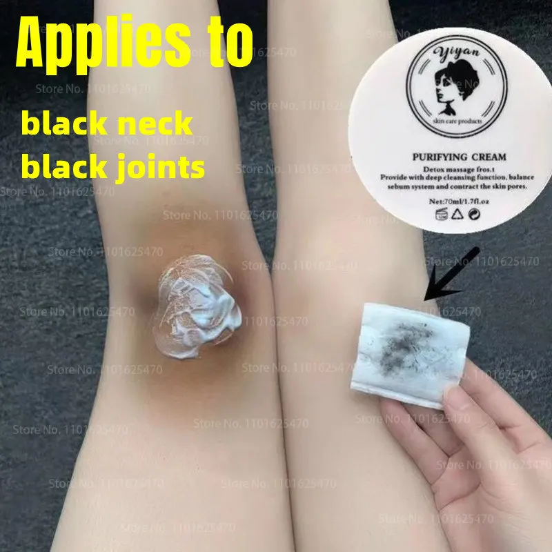 Anti Acanthosis Nigricans Whitening Cream Remove Melanin Armpit Elbow Private Care Products Body Butt Black Sitting Print Remov
Anti Acanthosis Nigricans Whitening Cream Remove Melanin Armpit Elbow Private Care Products Body Butt Black Sitting Print Remov