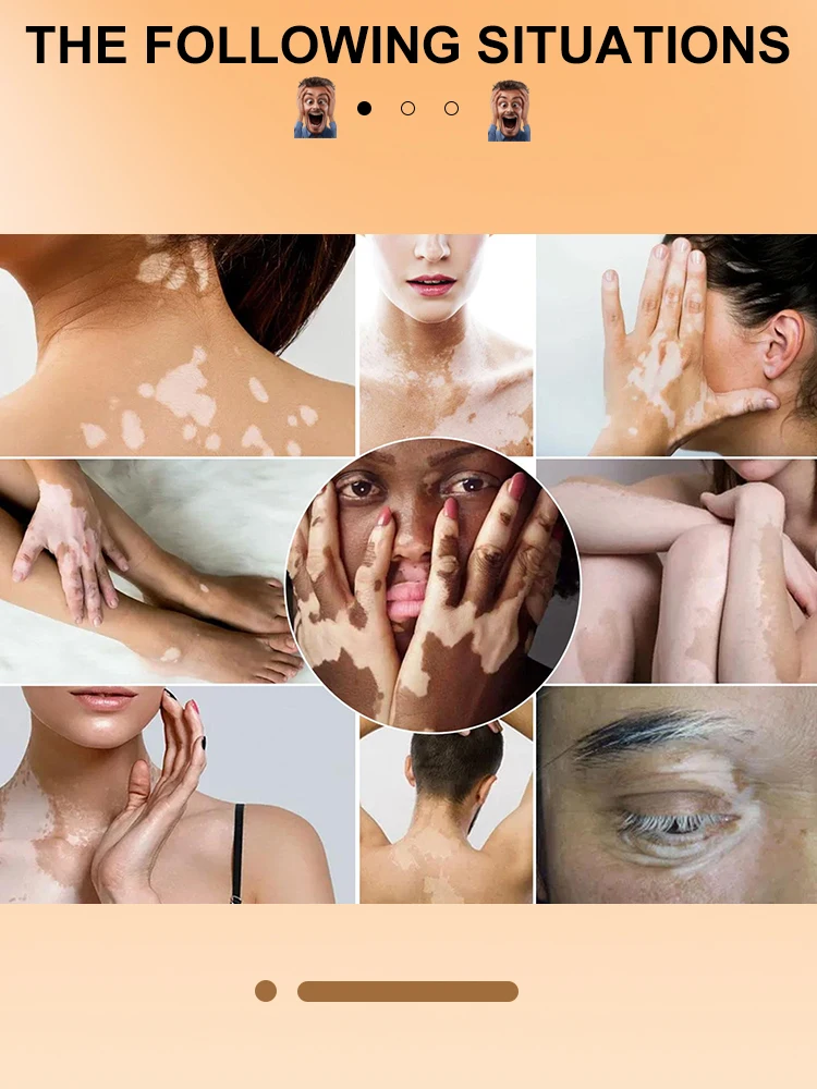 Vitiligo Repair Cream Get rid of ringworm White spots Get rid of skin vitiligo Eliminate vitiligo
Vitiligo Repair Cream Get rid of ringworm White spots Get rid of skin vitiligo Eliminate vitiligo