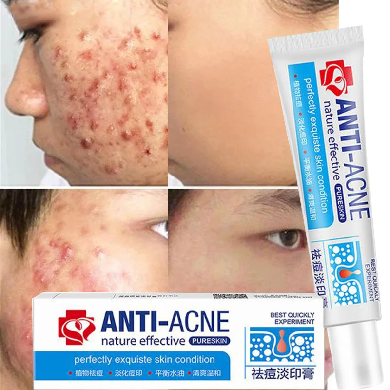 Effective Acne Removal Cream Treatment Acne Scars Spots Fade Acne Print Control Oil Whitening Pore Shrinkage Face Skin Care 30g
Effective Acne Removal Cream Treatment Acne Scars Spots Fade Acne Print Control Oil Whitening Pore Shrinkage Face Skin Care 30g