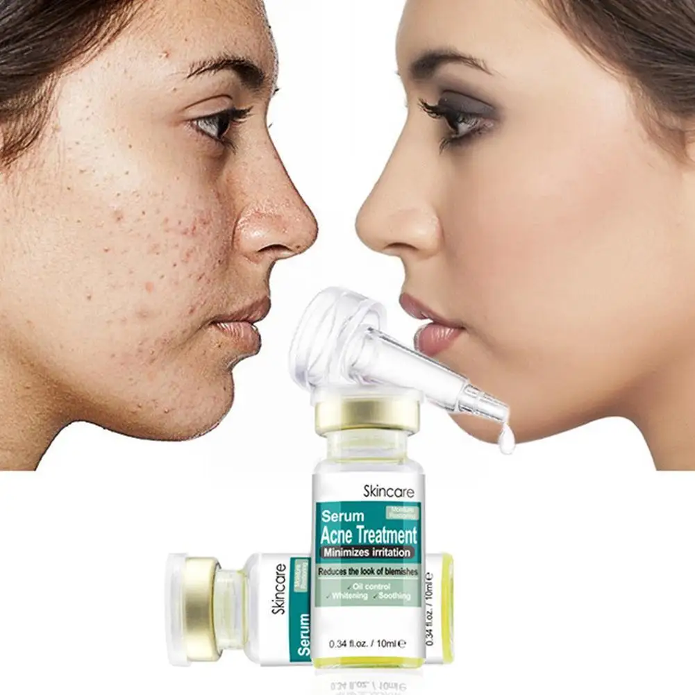 Acne Treatment Serum Face Care Cream Oil-control Acne Removal Anti And Face Whitening Serum Care Scar Skin Wrinkle M M3q5
Acne Treatment Serum Face Care Cream Oil-control Acne Removal Anti And Face Whitening Serum Care Scar Skin Wrinkle M M3q5