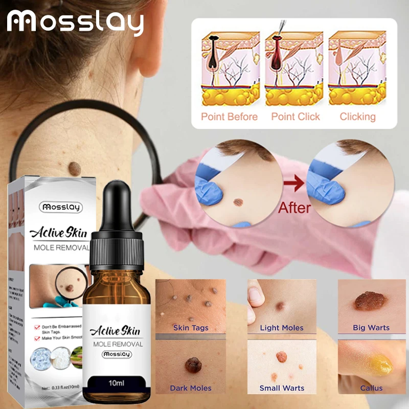 Remover Warts Treatment Meat Corn Skin Flat Wart Antibacterial Liquid Foot Calluses Skin Care Cream Removal Relief Medical
Remover Warts Treatment Meat Corn Skin Flat Wart Antibacterial Liquid Foot Calluses Skin Care Cream Removal Relief Medical