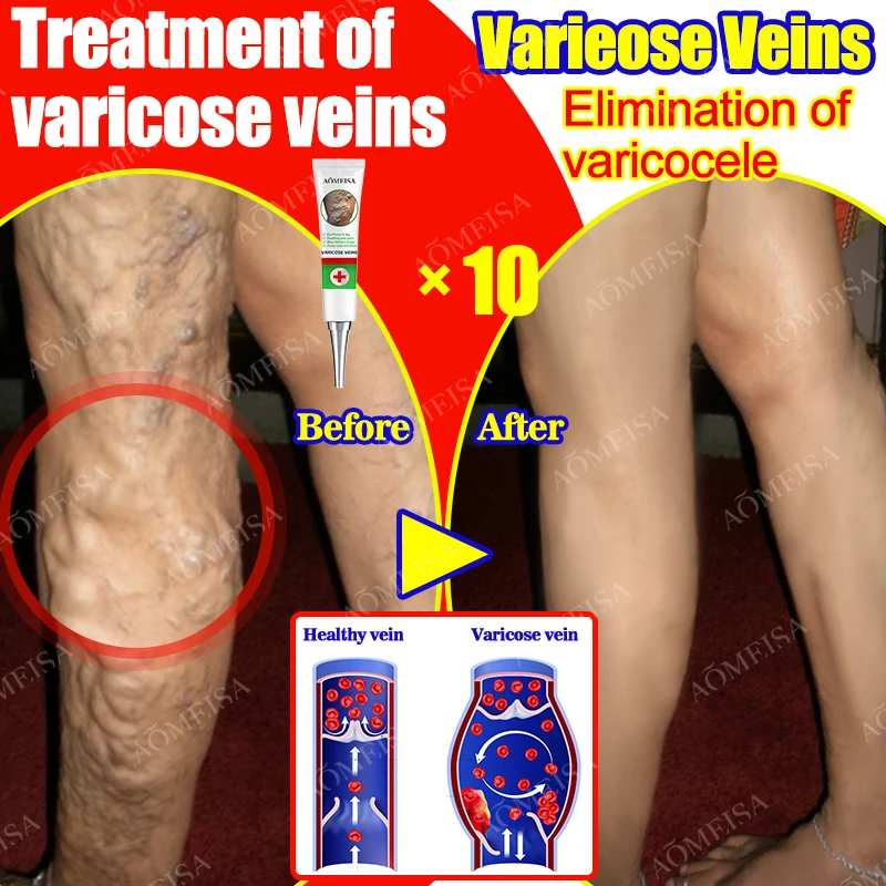 Effective Varicose Vein Relief Cream Ointment For Varicose Veins To Relieve Vasculitis Phlebitis Spider Pain Treatment
Effective Varicose Vein Relief Cream Ointment For Varicose Veins To Relieve Vasculitis Phlebitis Spider Pain Treatment