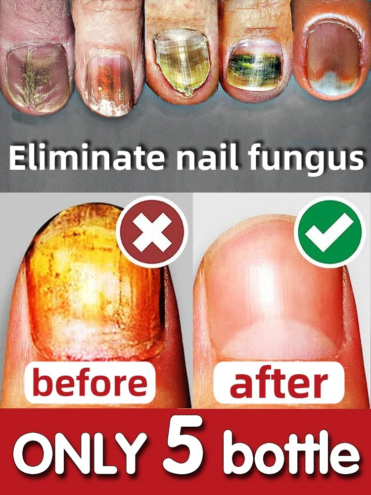 Nail Fungal Treatment Serum Onychomycosis Paronychia Anti Infection Toe Fungus Hand Foot Removal Repair Gel Care Beauty Health
Nail Fungal Treatment Serum Onychomycosis Paronychia Anti Infection Toe Fungus Hand Foot Removal Repair Gel Care Beauty Health