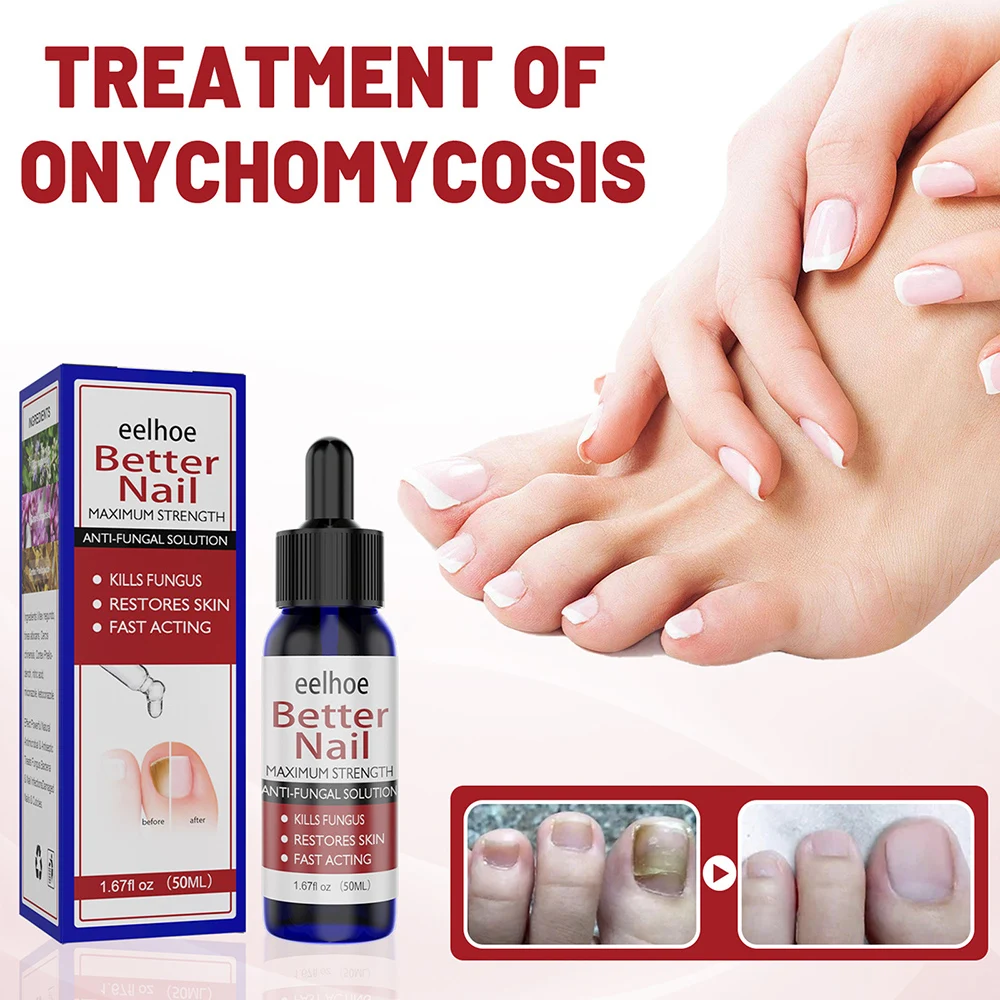 Herbal Essence Antibacterial Nail Treatments Essential Oil Nails Fungus Repair Nails Nutrient Solution Foot Nail Care Product
Herbal Essence Antibacterial Nail Treatments Essential Oil Nails Fungus Repair Nails Nutrient Solution Foot Nail Care Product