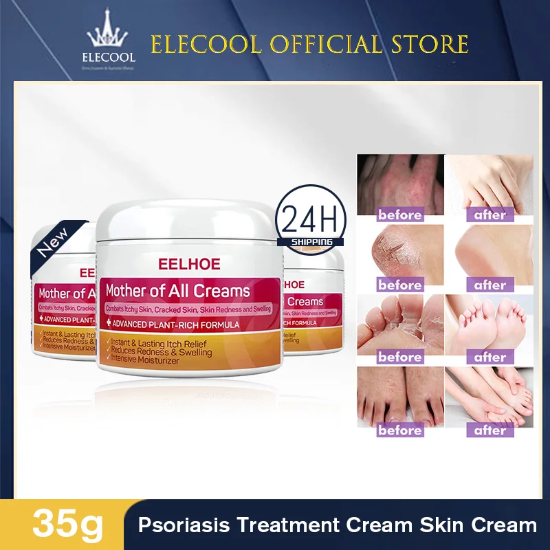 EELHOE Psoriasis Cream Eczema Ointment Psoriasis Treatments Hand Tinea Foot Odor Inhibit Dermatitis Fungus Anti-itch Cream Cares
EELHOE Psoriasis Cream Eczema Ointment Psoriasis Treatments Hand Tinea Foot Odor Inhibit Dermatitis Fungus Anti-itch Cream Cares