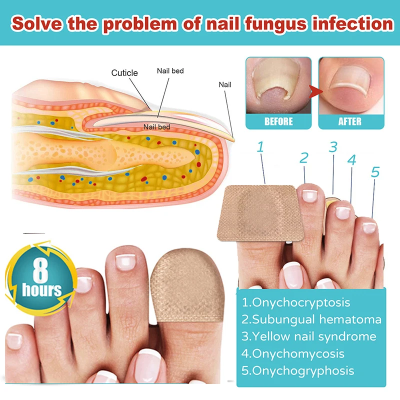 16Pcs Nail Treatment Patch Anti Fungal Nail Correction Stickers Ingrown Toenail Care Paronychia Anti Infection Repair Patch 
16Pcs Nail Treatment Patch Anti Fungal Nail Correction Stickers Ingrown Toenail Care Paronychia Anti Infection Repair Patch