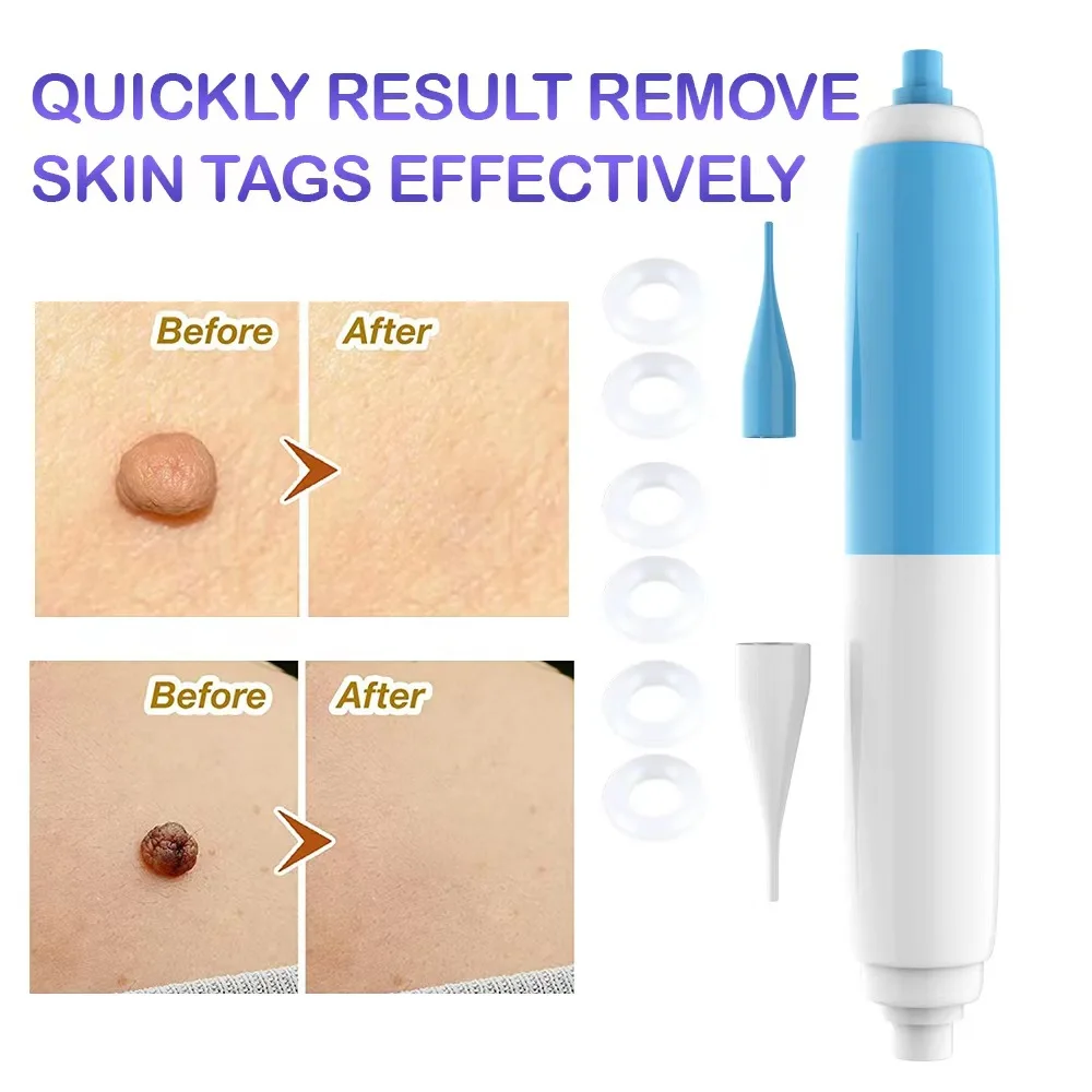 Painless Mole Remover Skin Tag Removal Kit Auto Tag Remover Wart Spot Skin Tag Removal Kit Body Face Neck Skin Tag Cleansing
Painless Mole Remover Skin Tag Removal Kit Auto Tag Remover Wart Spot Skin Tag Removal Kit Body Face Neck Skin Tag Cleansing