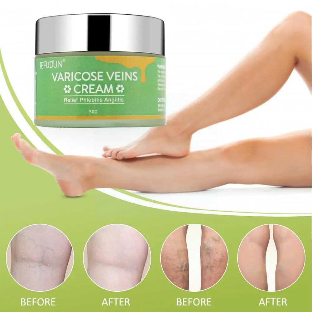 50g Varicose Veins Treatment Cream Relieve Tired Legs Body Dilated Spider Relief Pain Ointment Care Vasculitis Phlebitis U4n8
50g Varicose Veins Treatment Cream Relieve Tired Legs Body Dilated Spider Relief Pain Ointment Care Vasculitis Phlebitis U4n8