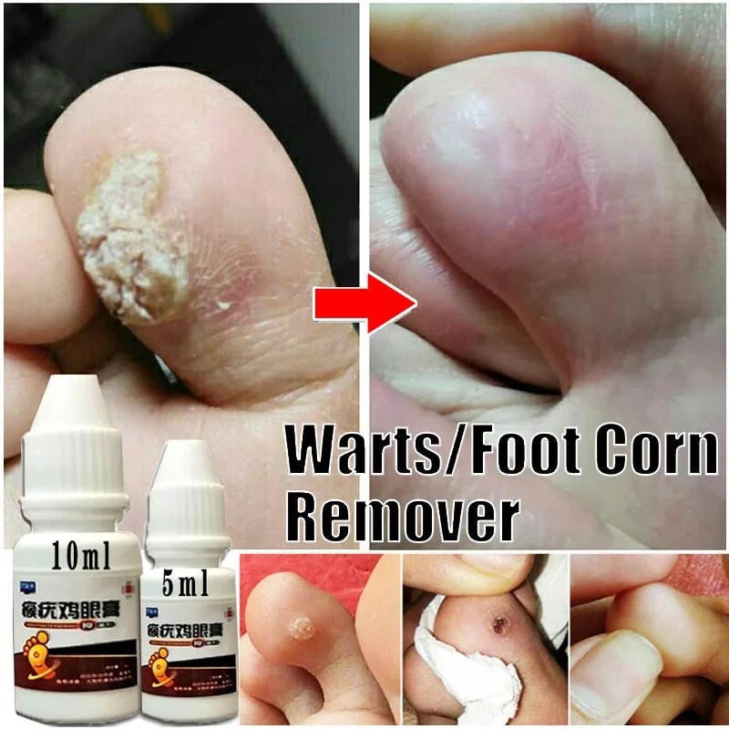 10ml/5ml Remover Foot Corn Care Cream Medical Plaster Treatment Warts Thorn Cream Corn of Removal foot Calluses Callosity Detox
10ml/5ml Remover Foot Corn Care Cream Medical Plaster Treatment Warts Thorn Cream Corn of Removal foot Calluses Callosity Detox