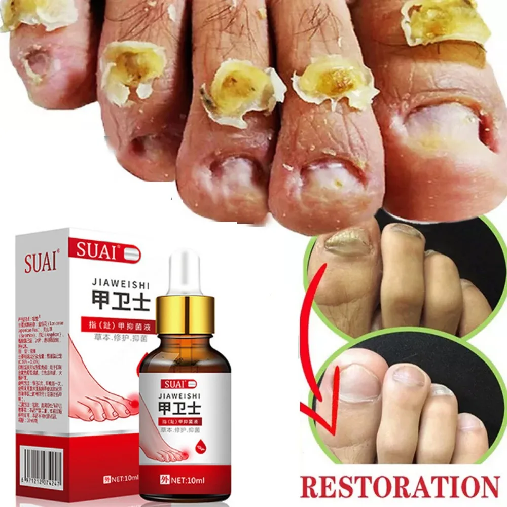 Care Essential Oil Foot Care Anti Infection Nail Fungal Toe Be Health Toenail Cleansing Ingrown Toenail Repair
Care Essential Oil Foot Care Anti Infection Nail Fungal Toe Be Health Toenail Cleansing Ingrown Toenail Repair