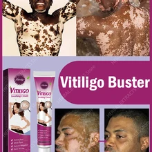 Vitiligo Repair Cream Original Vitiligo Whitening Cream Direct Attack Decolorization, No Need To Worry About Whiteboard Skin