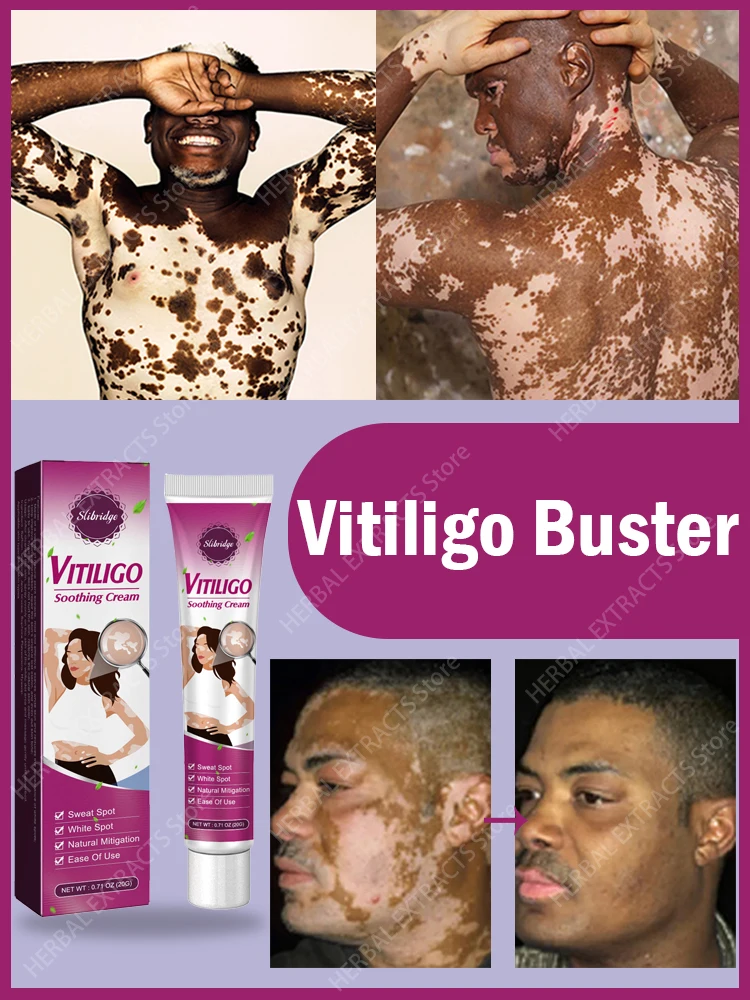 

Vitiligo Repair Cream Get rid of ringworm White spots Get rid of skin vitiligo Eliminate vitiligo