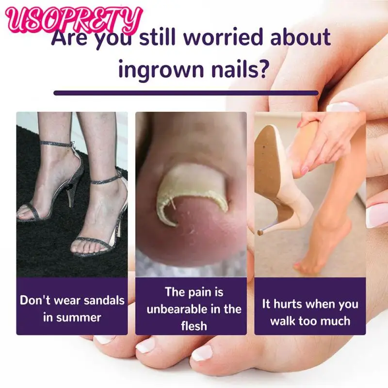 Nail Correction Stickers Ingrown Toenail Corrector Toe Nail Patches Paronychia Recover Repair Nails Foot Pedicure Tool 
Nail Correction Stickers Ingrown Toenail Corrector Toe Nail Patches Paronychia Recover Repair Nails Foot Pedicure Tool