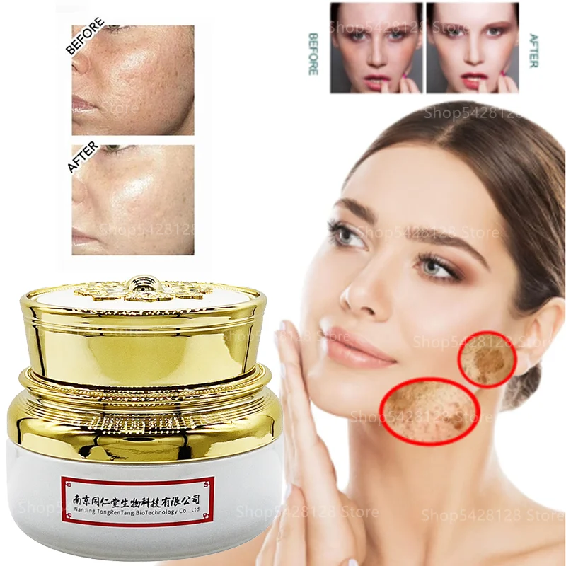 Facial Whitening and Freckle Removal Cream Remove Melanin Freckle Remove Yellow Age Spots Chloasma Freckles Facial Care
Facial Whitening and Freckle Removal Cream Remove Melanin Freckle Remove Yellow Age Spots Chloasma Freckles Facial Care
