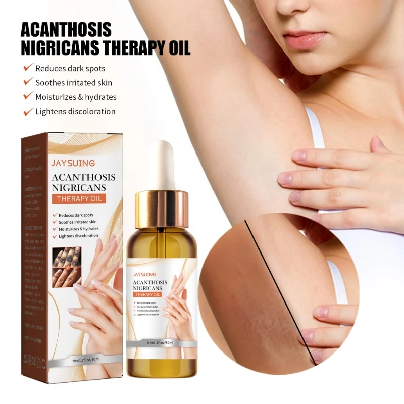 Масло для лечения Acanthosis Nigricans Масло для терапии Acanthosis Nigricans Темные колени
Масло для лечения Acanthosis Nigricans Масло для терапии Acanthosis Nigricans Темные колени
